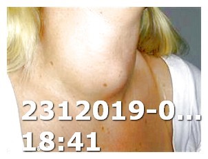 Viagra Dosage Maximum